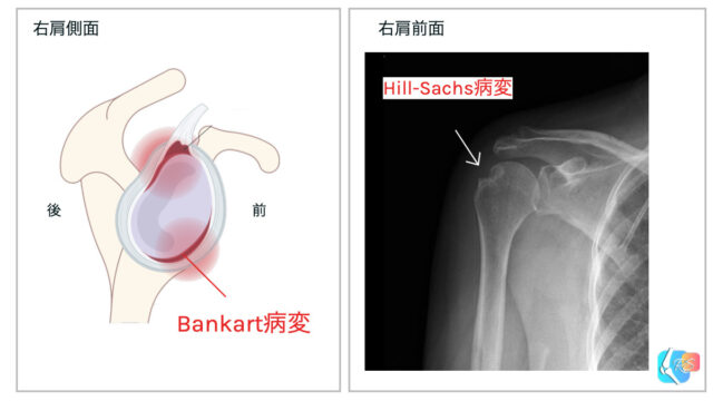 bankart病変　バンカート　Hill-Sachs病変　ヒルサックス